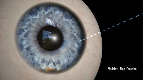 Creation of a bladeless Z LASIK flap