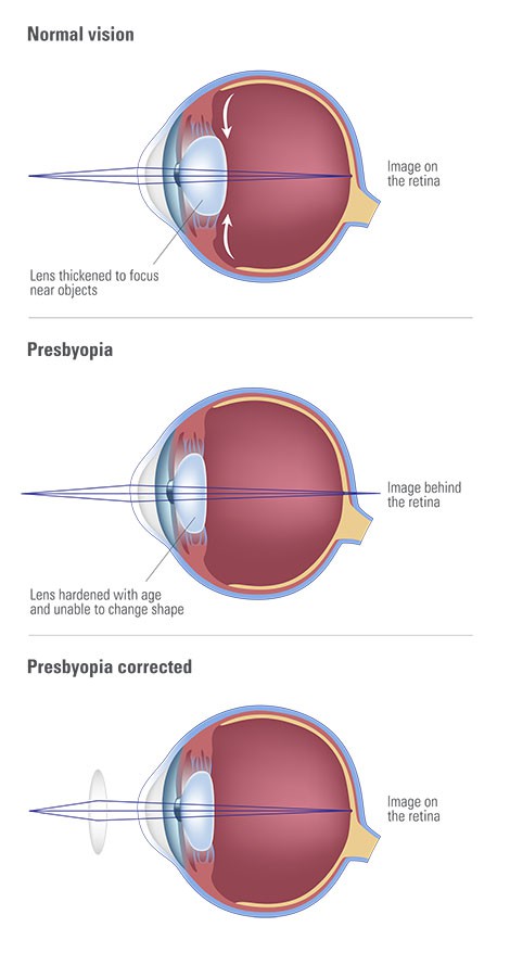 Mi a myopia lézer. A rövidlátás (myopia), a korszerű korrekció módszerei - Rövidlátás September